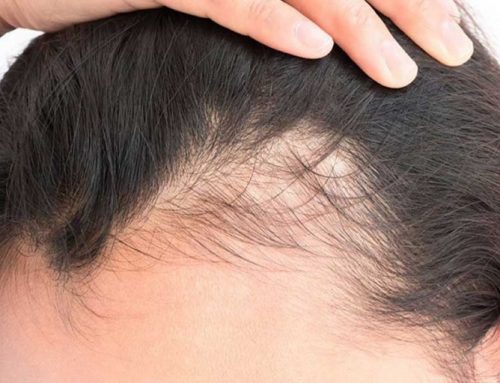 ¿Qué causa la caída del cabello y cómo detenerla de una vez por todas?